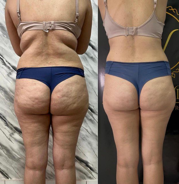 Antes e depois de tratamento para celulite