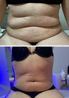 Antes e depois de cliente com +Curvas
