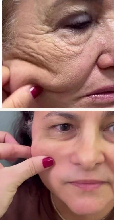Antes e depois do Full Face Crio